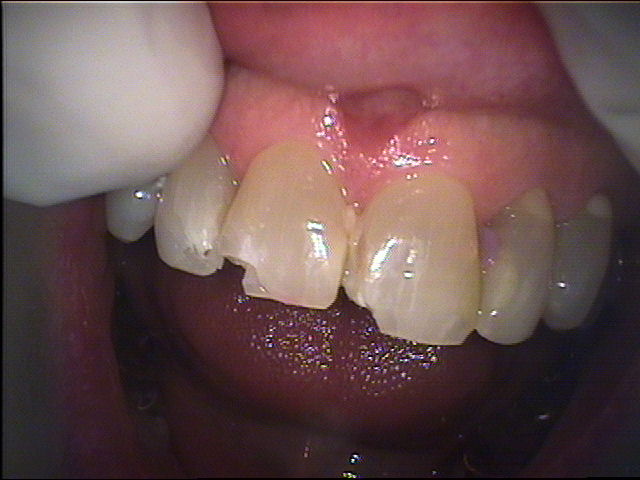 Chipped Tooth